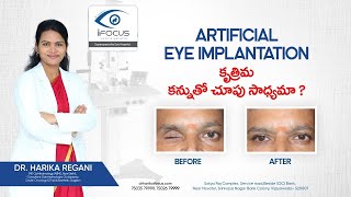 Artificial Eye Implantation  Dr Harika Regani  Ophthalmologist in Vijayawada [upl. by Greiner590]