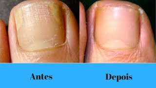 Como eliminar Micose das Unhas [upl. by Onairotciv707]