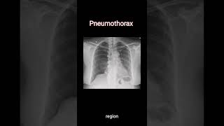 Diagnose Pneumothorax on chest Xray radiology cxr [upl. by Jeavons]