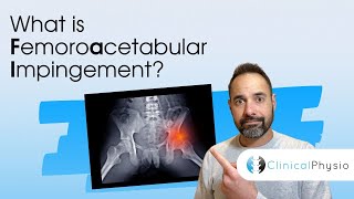 What is Femoroacetabular Impingement  Expert Physio Review [upl. by Atteuqram89]