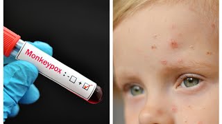 What is Mpox  Types Causes Sign amp Symptoms Treatment Prevention  Dr Rafiq  mpox mpoxvirus [upl. by Stevana]