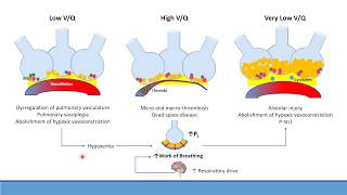 Update on Understanding Pathology and Mangement of Respiratory Failure in COVID 19 Patients [upl. by Ayk]