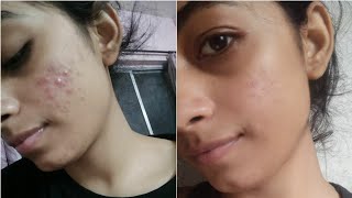 Tretinoin 005 cream review  My experience  Riddhi Pethad [upl. by Mauretta303]