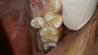 Exodontia malposed Upper Premolar [upl. by Itagaki594]