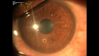 Superficial Corneal FB removal  Dr PL APPROACH [upl. by Ennairek]