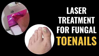 Laser Treatment For Fungal Toenails [upl. by Yanrahc]