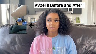 KYBELLA BEFORE AND AFTER [upl. by Ytsanyd]