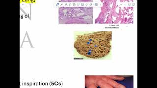 RS pathology 5 restrictive lung diseases [upl. by Billat247]