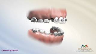 Orthodontic Treatment for Kids  2x4 Braces [upl. by Eras]