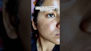 Using adapalene amp benzoyl peroxide gel in acne prone skin skin peel adapalenebenzoylperoxideacne [upl. by Agate]