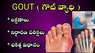 GOUT Causes Symptoms and Treatment in Telugu [upl. by Annasiul]