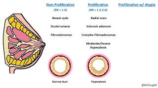 UltrasoundGuided Breast Biopsy with subtitles [upl. by Adnaw]