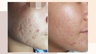 REAL and LEGIT ACNE SCARS TREATMENT SOLUSYON SA ACNE SCARS  ACNE SCAR REMOVAL AcneScarJourney [upl. by Anole916]