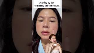 Melasma Cream 40 Off Today [upl. by Itnuahsa732]