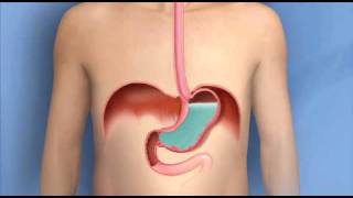 Heartburn Acid Reflux GERDMayo Clinic [upl. by Ahsikram]