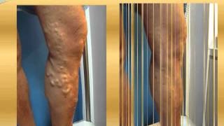 Varicose vein before and after Part 3  varicose vein treatment varicose surgery [upl. by Sel691]