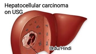 Liver mass on ultrasound Abdominal Ultrasound Hepatic focal lesion on ultrasound [upl. by Shaw]