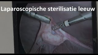 Laparoscopische sterilisatie leeuw [upl. by Ocnarf]