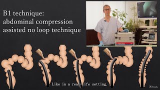 Colonoscopy Insertion Technique with Mikoto Model How to use abdominal compression [upl. by Osborne]