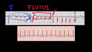 CURSO DE ELECTROCARDIOGRAFIA 26  ONDA P [upl. by Enomes393]