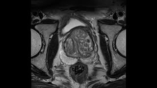 Introduction to Prostate MRI and PIRADS Approach and Principles [upl. by Anivid]