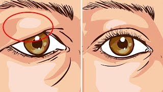 How To Treat Droopy Eyelids Naturally The Results Are Amazing [upl. by Mure]