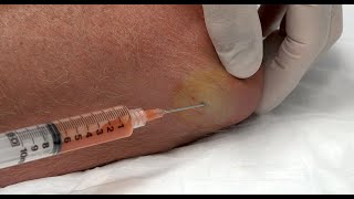 Elbow Effusion Aspirated for Sudsy Olecranon Bursitis Effusion [upl. by Acirtal]