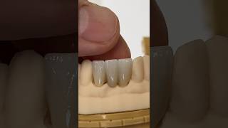 3Unit Bridge EnvisiontecMain envisiontec dental teeth smile lsk121shorts shortvideoshorts [upl. by Minta]