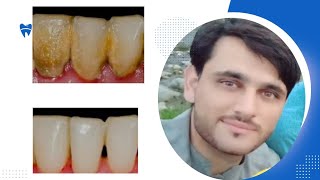 Dental scaling teeth cleaning benifits of scaling [upl. by Symon]