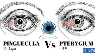 आँख में पीले धब्बे । Yellow spot in eye । how to cure from yellow eye  Pterygium and Pinguecula [upl. by Sucam]