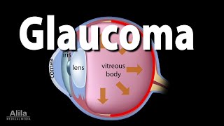 Development of Glaucoma Animation Open Angle vs Angle Closure Glaucoma [upl. by Ainitsirhc963]