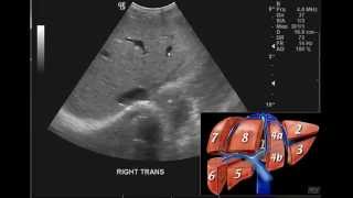 Introduction to the interpretation of Abdominal Ultrasound [upl. by Sivrep640]