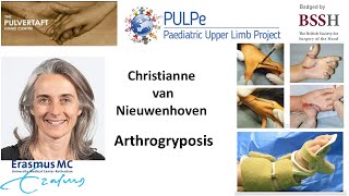 Arthrogryposis by Dr Christianne van Nieuwenhoven [upl. by Libbie645]