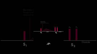 Pulmonic Stenosis [upl. by Mcneely]