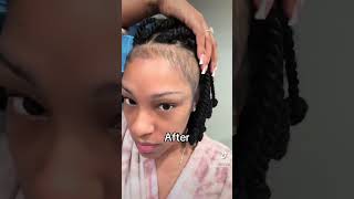 I grew my edges back using Minoxidil 5 minoxidil hairloss beforeandafter hairgrowth alopecia [upl. by Scottie]