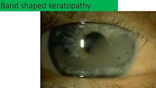 Band shaped keratopathy explained [upl. by Nylynnej]