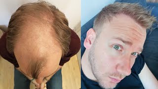 Hair Transplant Before and After  Month by Month results Elithair 8 [upl. by Deane802]