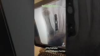 podiatry fracture bone operation surgery ouch xray [upl. by Ailehpo]