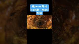 How to find a Fistula Tract MRI pelvic region is the gold standard Test [upl. by Maroj799]