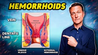 The 1 Best Remedy for Hemorrhoids  Dr Berg [upl. by Akenot]