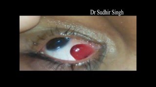 Conjunctival Pyogenic Granuloma Excision Video Under Topical Anesthesia 122 [upl. by Zelle534]