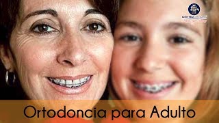 Ortodoncia para adultos [upl. by Leterg]