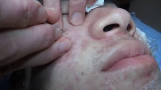 Popping Blackheads and Pimples for Day 4 [upl. by Dayir]