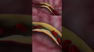 Thrombotic ischemic stroke doctor science biology film4health hospital [upl. by Ivek489]