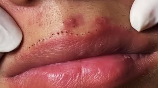 Lips Blackhead removal Video 53 Blackheads blackheadsremoval sebum [upl. by Hanan332]