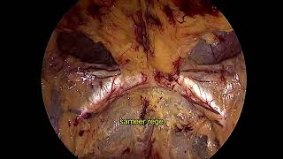 Laparoscopic bilateral TEP with plication of Pseudosac [upl. by Agn]