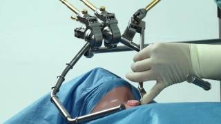 Mini System for thyroid surgeries  Condor GoldLine retractor system [upl. by Ellehcir]