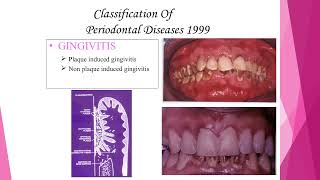 7classification of periodontal dseases [upl. by Vashtia]