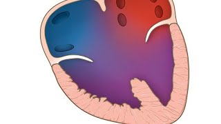 Hydrops fetalis because of cardiac anomaly  Atrioventricular septal defects AVSDs [upl. by Ackley]