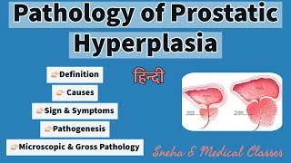 Prostate Cancer  Pathology mini tutorial [upl. by Enilraep]